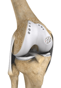 Knee Preservation Surgery