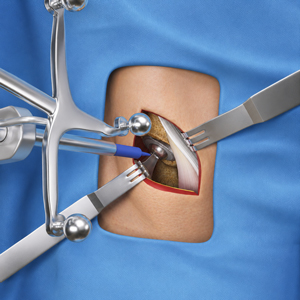 Muscle Sparing Robotic Assisted Hip Replacement