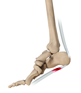 Plantar Fasciitis