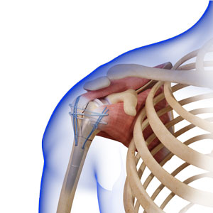 Reverse Total Shoulder Arthroplasty for Fracture pic