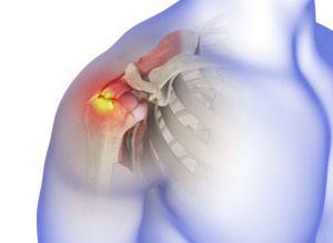 Rotator Cuff Tear pic
