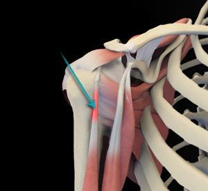 Shoulder Tendonitis pic