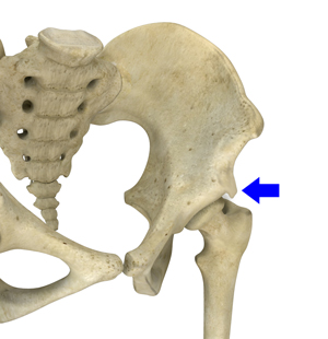 Subspine Impingement