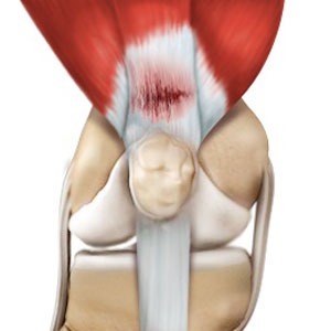 Tendon Injuries