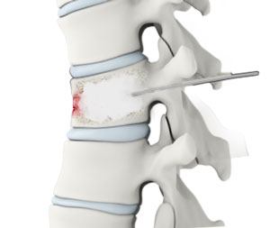 Thoracic Kyphoplasty