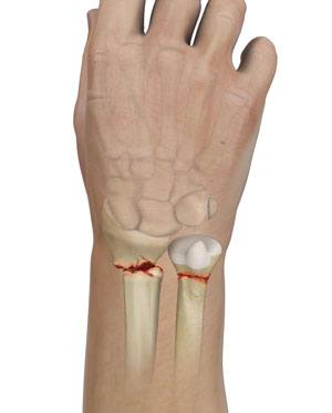 Wrist Fracture pic
