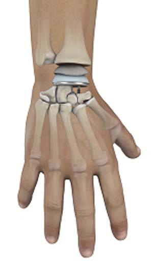Wrist Joint Replacement pic
