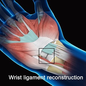 Wrist Ligament Reconstruction pic