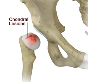 Chondral Lesions or Injuries of the Hip - Educational Picture
