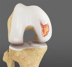 Chondral or Articular Cartilage Defects - Educational Picture