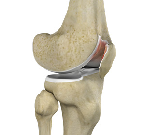 Chondromalacia Patella - Educational Picture