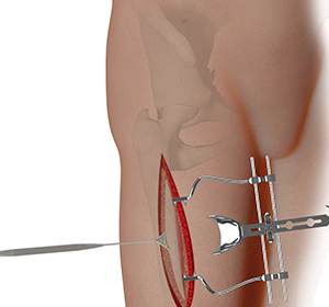 Complex Hip Reconstruction Surgery - Educational Picture
