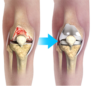 Complex Total Knee Replacement - Educational Picture