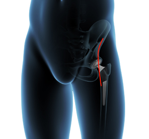 Direct Anterior Hip Replacement - Educational Picture