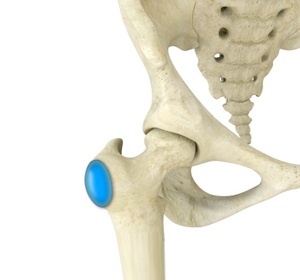 Hip Bursitis - Educational Picture