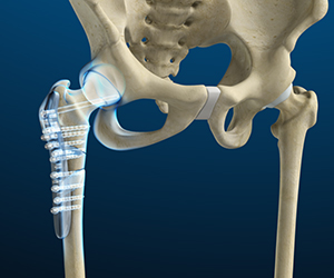 Hip Fracture Surgery - Educational Picture