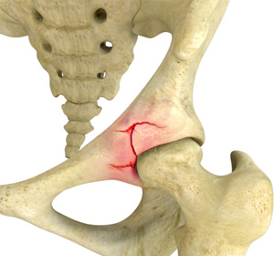 Hip Fracture - Educational Picture