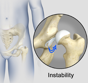 Hip Instability - Educational Picture