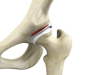 Hip Labral Tear - Educational Picture