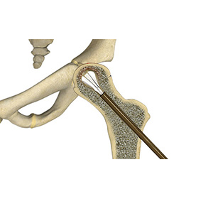 Hip Reconstruction - Educational Picture