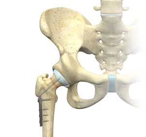 Hip Surgery - Educational Picture