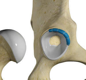 Hip Trauma Reconstruction - Educational Picture