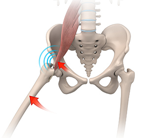 Iliopsoas Impingement - Educational Picture