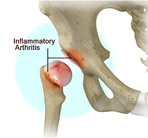 Inflammatory Arthritis of the Hip - Educational Picture