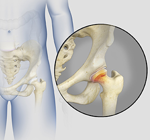 Irritable Hip - Educational Picture