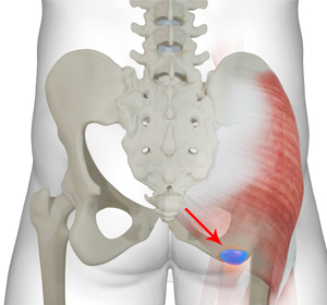Ischial Bursitis - Educational Picture