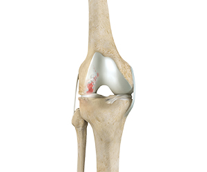 Knee Arthritis - Educational Picture