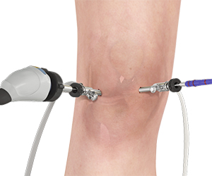 Knee Arthroscopy - Educational Picture