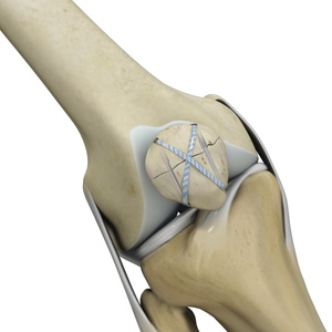 Knee Fracture Surgery - Educational Picture