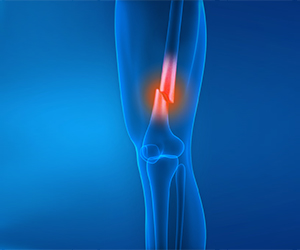 Knee Fracture - Educational Picture