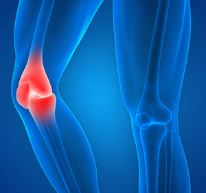 Knee Injury - Educational Picture