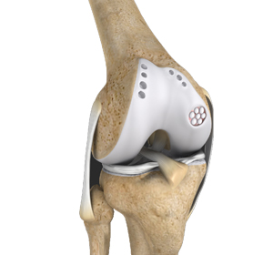 Knee Preservation Surgery - Educational Picture