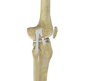 Knee Sprain - Educational Picture