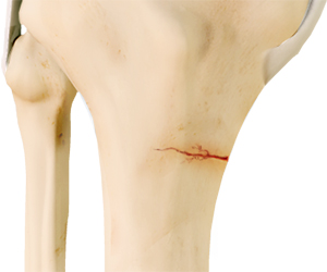 Knee Stress Fractures - Educational Picture