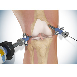 Knee Surgery - Educational Picture