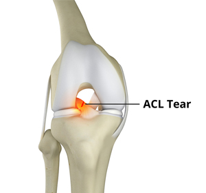 Knee Trauma - Educational Picture