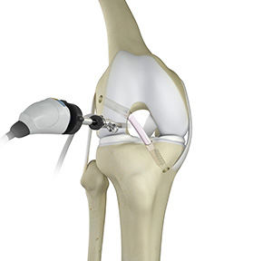 Knee Trauma Reconstruction - Educational Picture