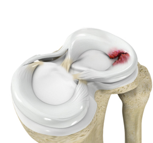 Meniscal Injuries - Educational Picture