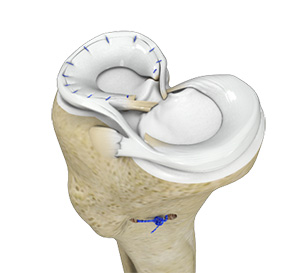 Meniscal Surgery - Educational Picture