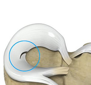 Meniscal Tears - Educational Picture
