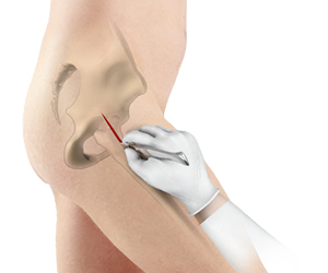 Minimally Invasive Total Hip Replacement - Educational Picture