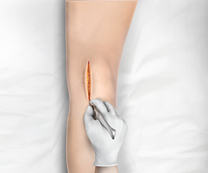 Minimally Invasive Knee Joint Replacement - Educational Picture