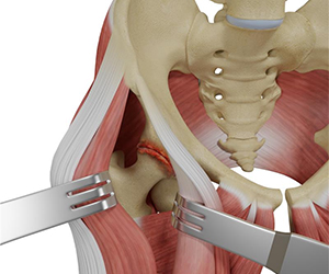 Muscle Sparing Anterior Hip Replacement - Educational Picture