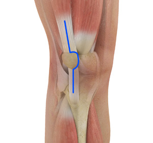 Muscle Sparing Total Knee Replacement - Educational Picture