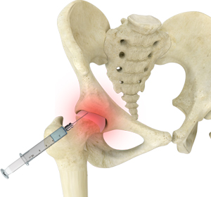 Nonoperative Management of Hip Arthritis - Educational Picture
