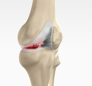 Nonoperative Management of Knee Arthritis - Educational Picture